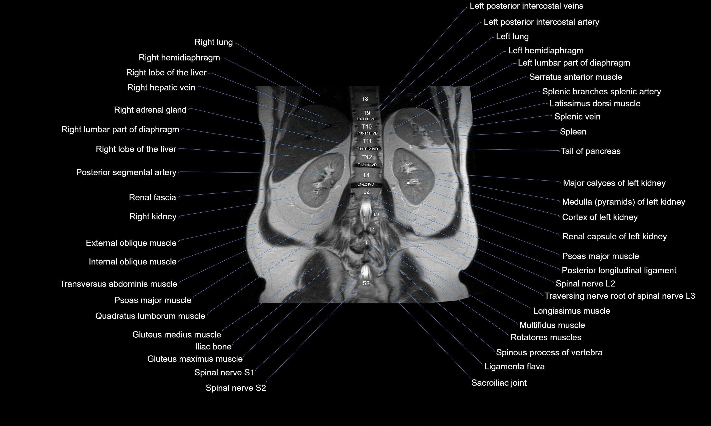 MRI Abdomen axial cross sectional anatomy radiology  image-img-00001-00042.webp